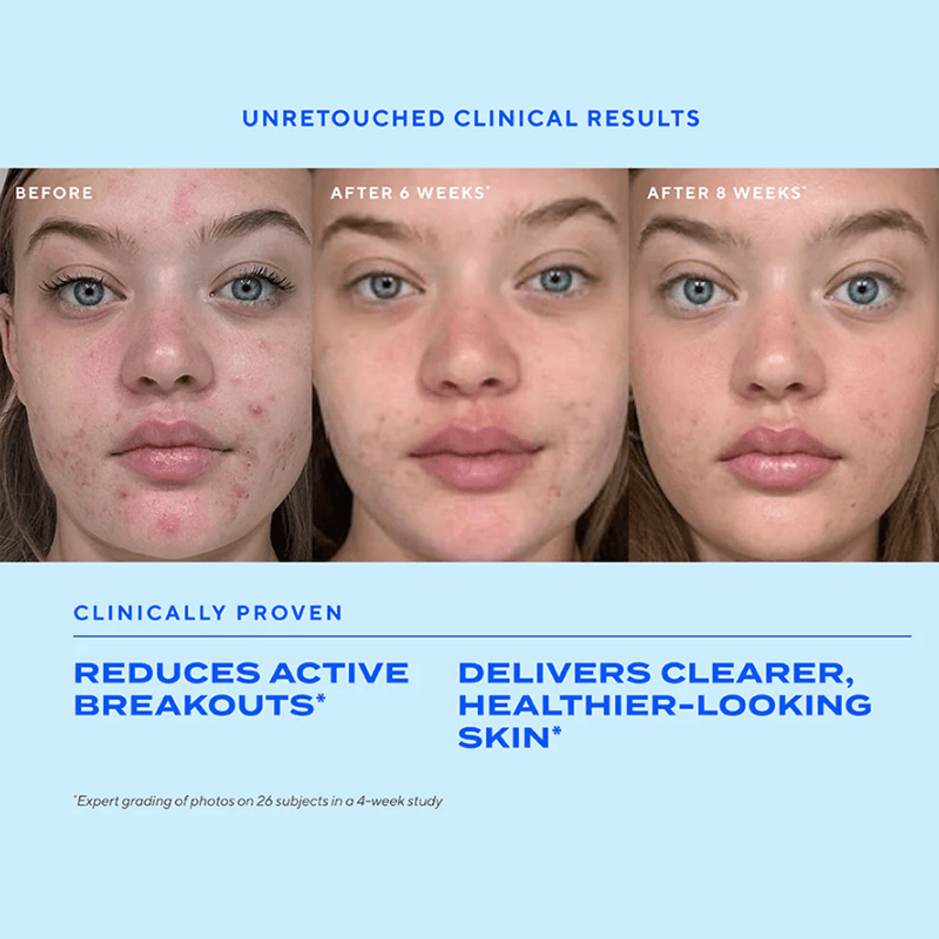 Biome-Balancing Clear & Prevent Acne Treatment Serum