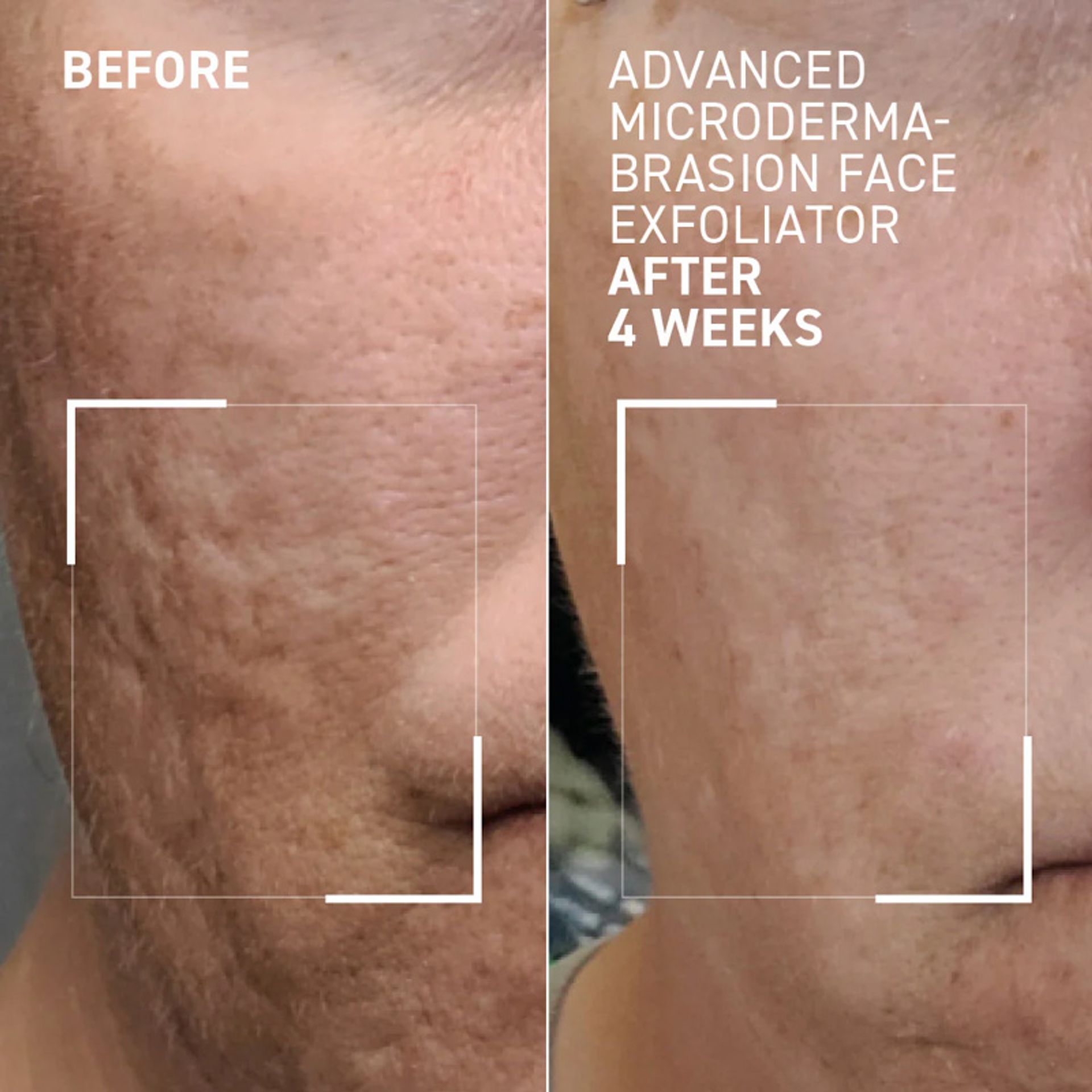 Advanced Microdermabrasion Face Exfoliator
