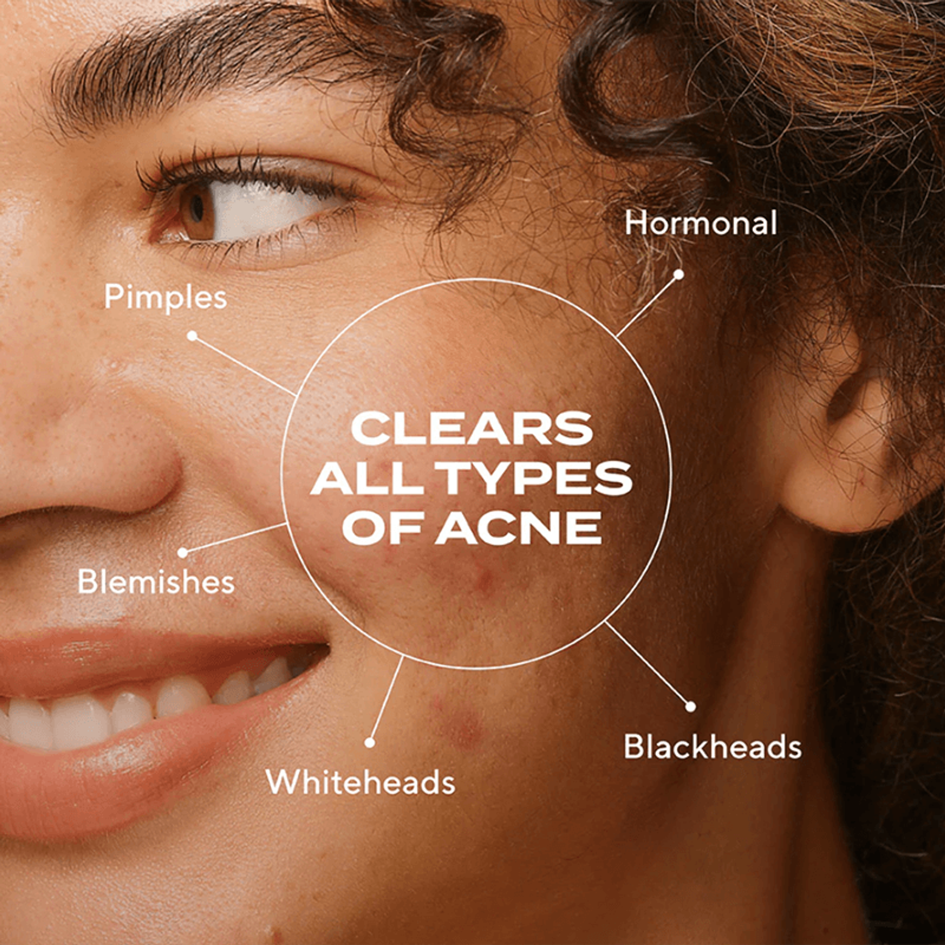 Biome-Balancing Clear & Prevent Acne Treatment Serum