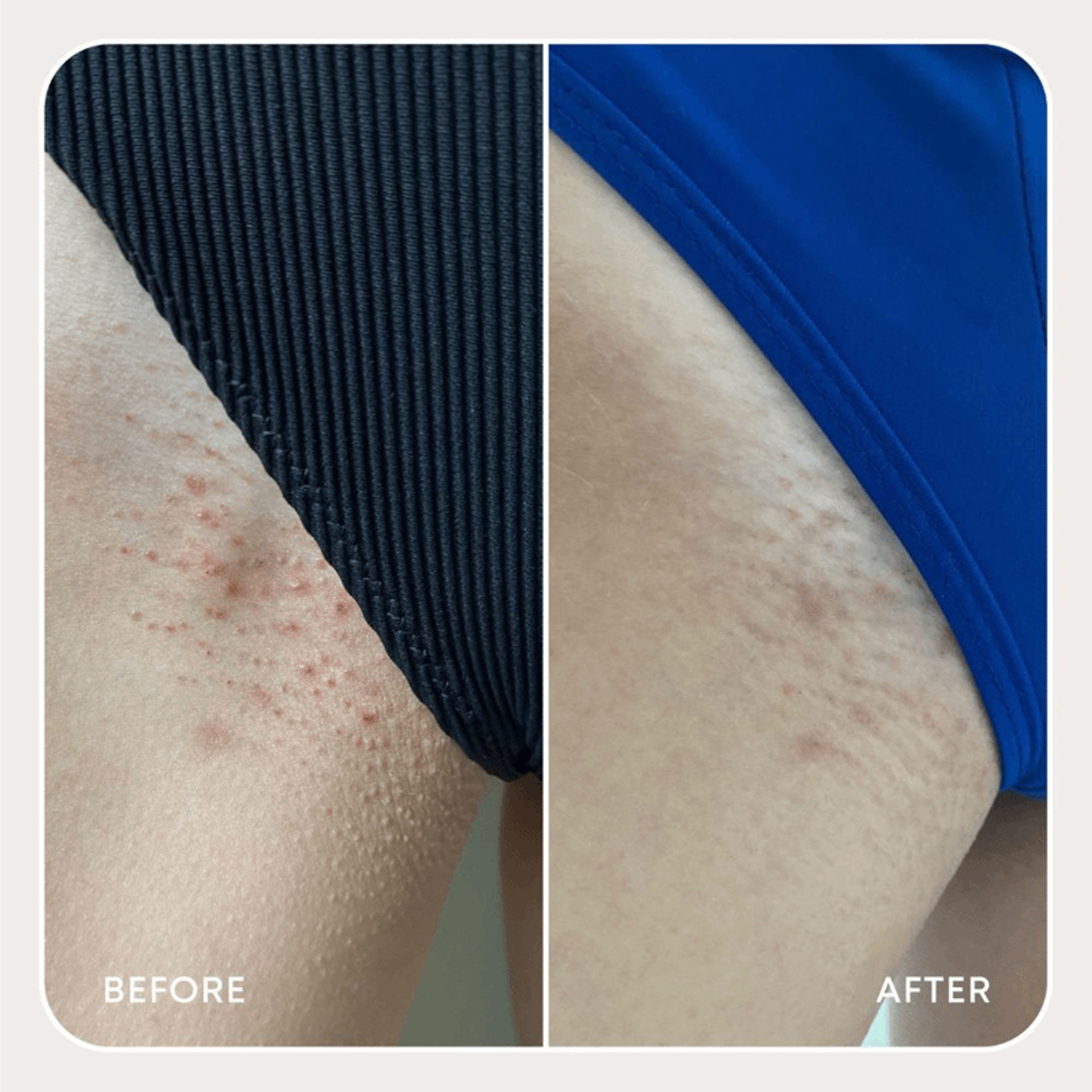 Ingrown Hair Exfoliating Scrub in Watermelon Sugar